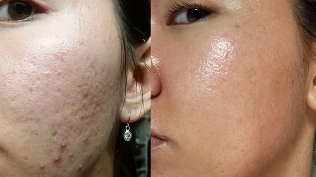 Before and after treatment